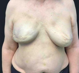 Breast Reconstruction
