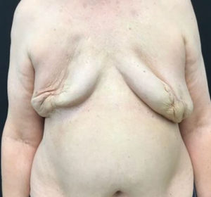 Breast Reconstruction
