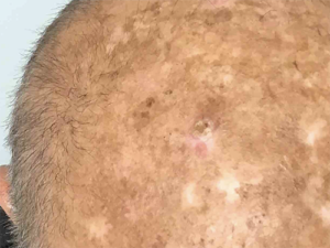 Squamous Cell Carcinoma