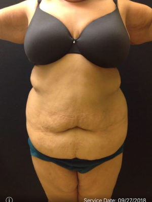 Tummy Tuck