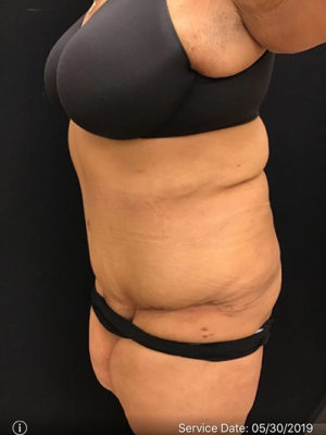 Tummy Tuck