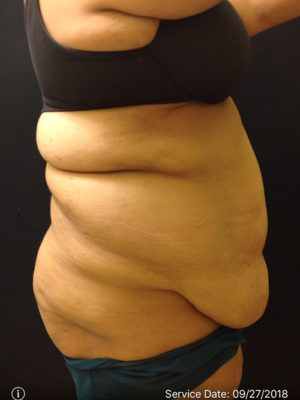 Tummy Tuck