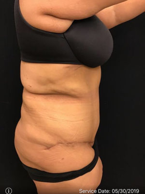 Tummy Tuck