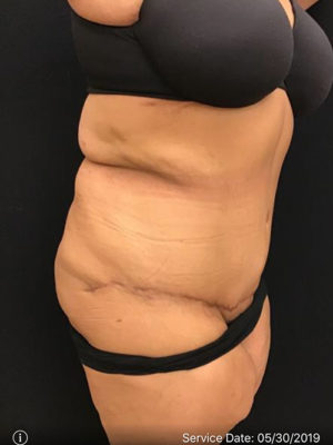 Tummy Tuck