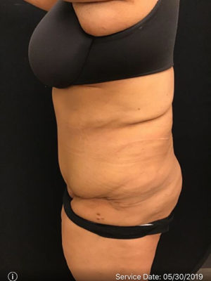 Tummy Tuck