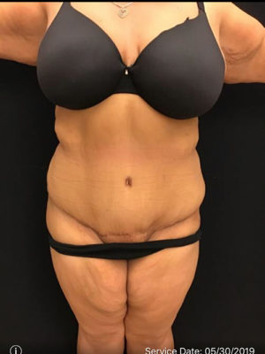 Tummy Tuck