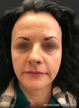 Around The Eye Fillers
