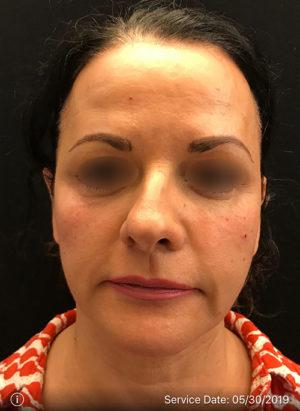 Around The Eye Fillers