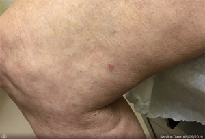 Squamous Cell Carcinoma