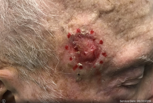 Squamous Cell Carcinoma