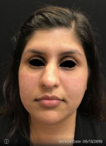 Around The Eye Fillers