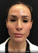 Around The Eye Fillers