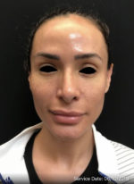 Around The Eye Fillers