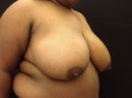 Breast Reduction