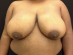 Breast Reduction