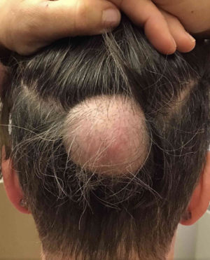 Scalp Reconstruction