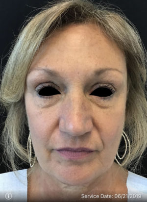 Around The Eye Fillers