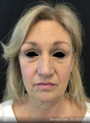 Around The Eye Fillers