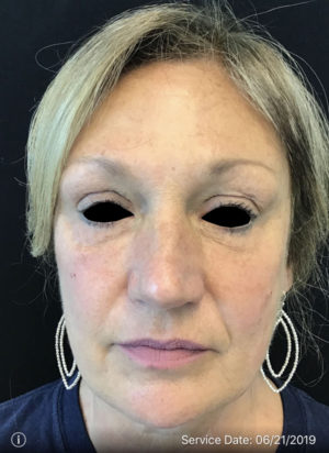Around The Eye Fillers
