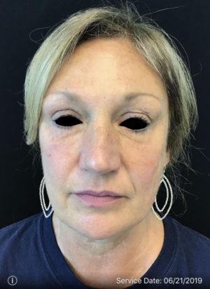 Around The Eye Fillers