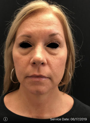 Around The Eye Fillers