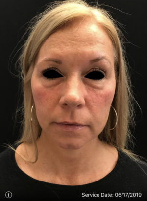 Around The Eye Fillers