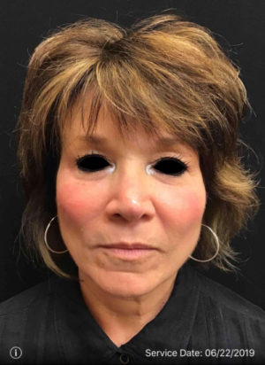 Around The Eye Fillers