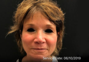 Around The Eye Fillers