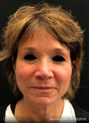 Around The Eye Fillers