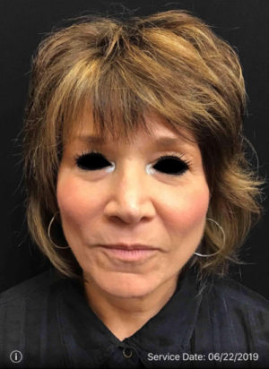 Around The Eye Fillers