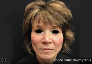 Around The Eye Fillers