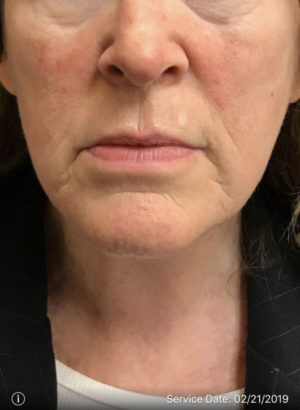 Around The Mouth Fillers