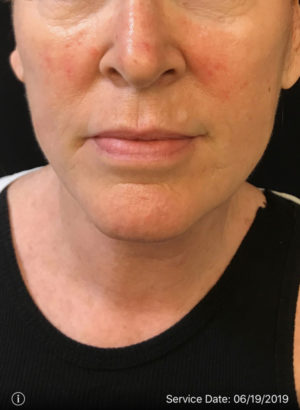 Around The Mouth Fillers