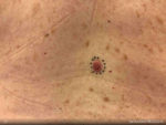 Basal Cell Carcinoma