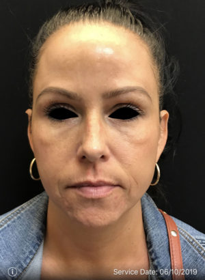 Botox Cosmetic and Dysport