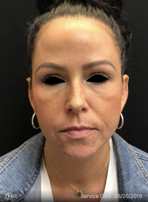 Botox Cosmetic and Dysport