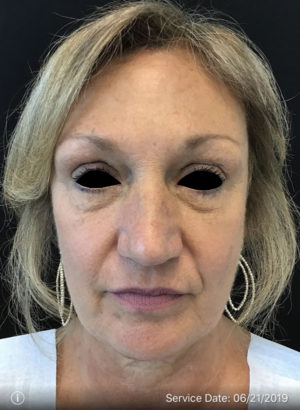 Botox Cosmetic and Dysport