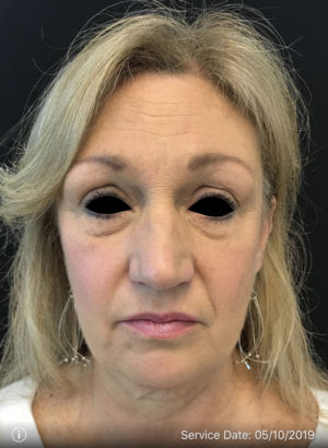Botox Cosmetic and Dysport