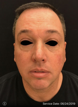 Around The Eye Fillers