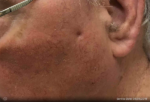 Basal Cell Carcinoma