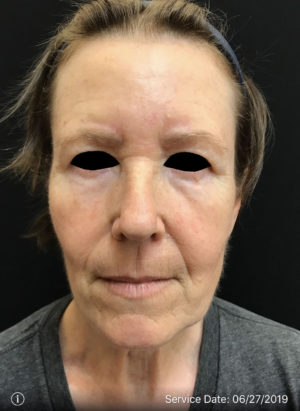 Botox Cosmetic and Dysport