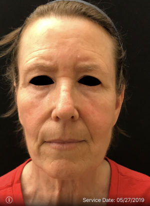 Botox Cosmetic and Dysport