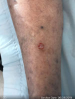 Squamous Cell Carcinoma