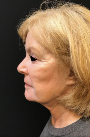 Nonsurgical Lift
