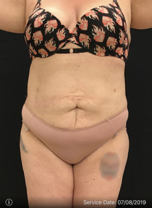 Liposuction
