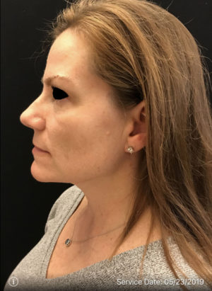 Sculptra