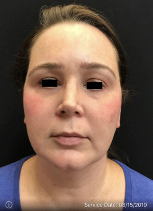 Around The Eye Fillers