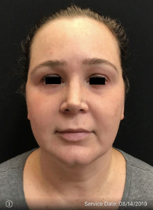 Around The Eye Fillers