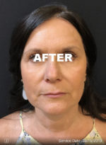 Botox Cosmetic and Dysport