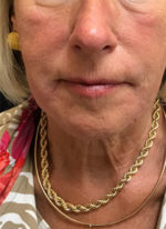 Around The Mouth Fillers